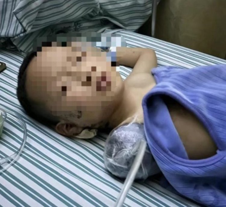 Tragis, Lengan Kanan Bocah Laki- laki di Jiangxi Terpaksa Diamputasi Usai Dilempar Petasan Oleh Saudara